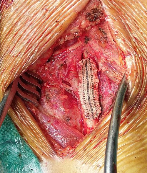 Chemoport Insertion for Cancer Chemotherapy, Dr. Kushan Nanavati