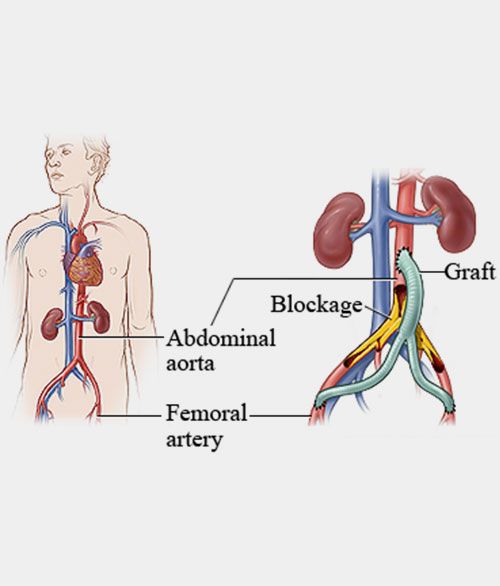 Vascular Bypass Surgery Leg Bypass Surgery By Dr Kushan Nanavati