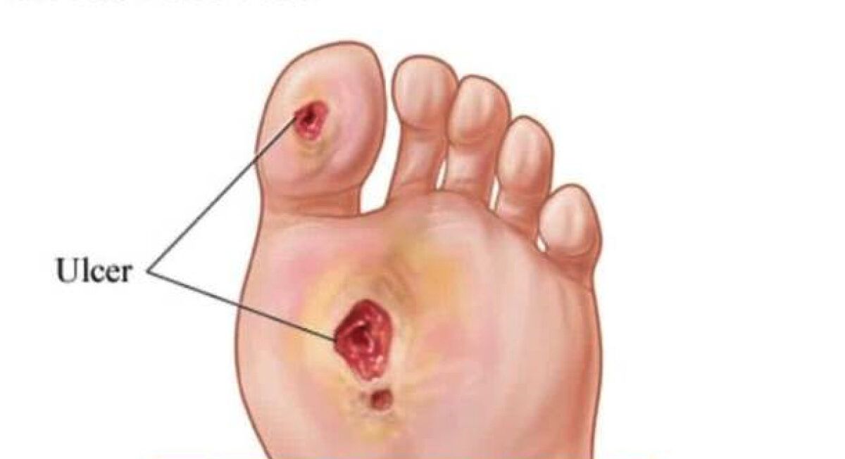 Foot Ulcer - Causes, Types, Symptoms, Treatment & Prevention