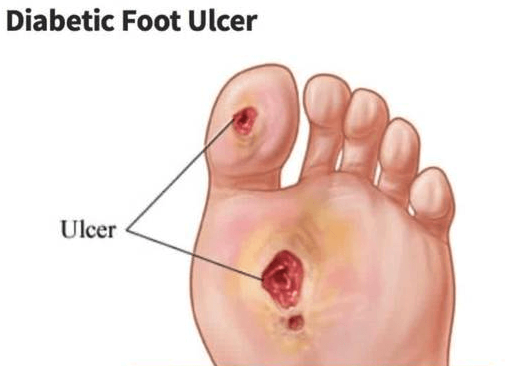 Treating foot sale ulcers